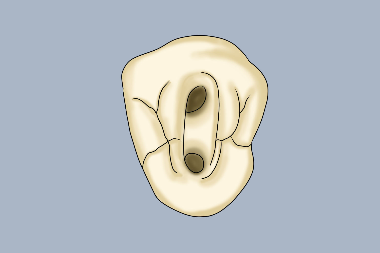 下颌前牙开髓洞形图