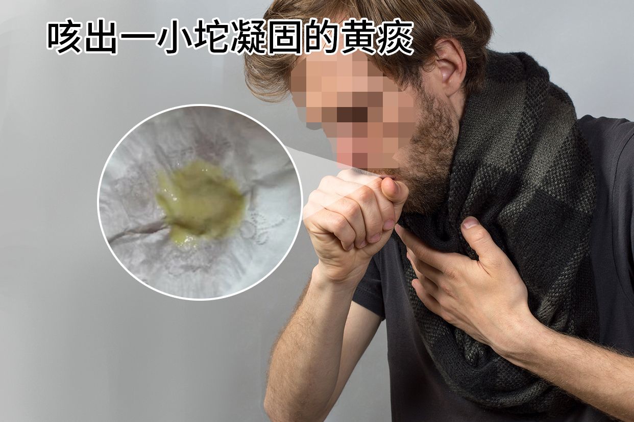 咳出一小坨凝固的黄痰图片