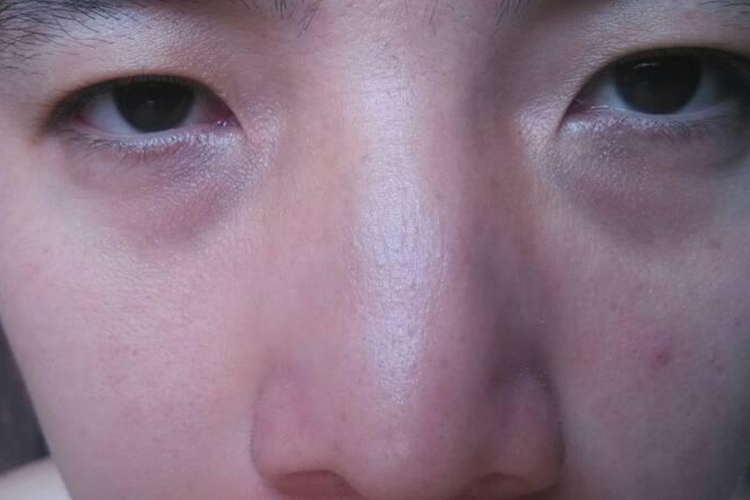 肾虚的黑眼圈是什么样子真实图片