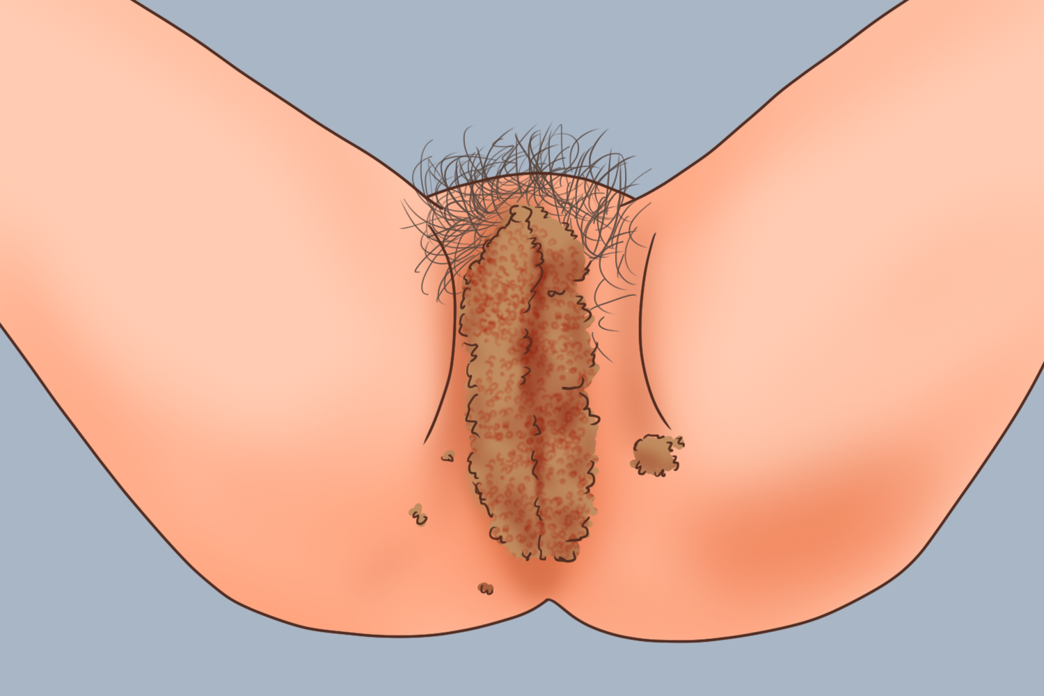 女性外阴巨大型尖锐湿疣图