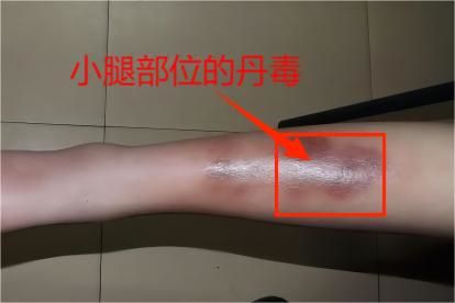 丹毒是什么病图片