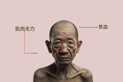 蛋白质缺乏症图片