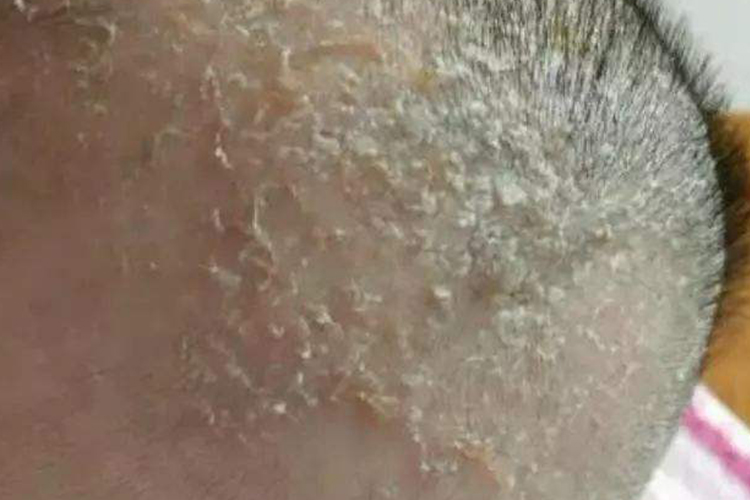 乳痂和湿疹的区别图片