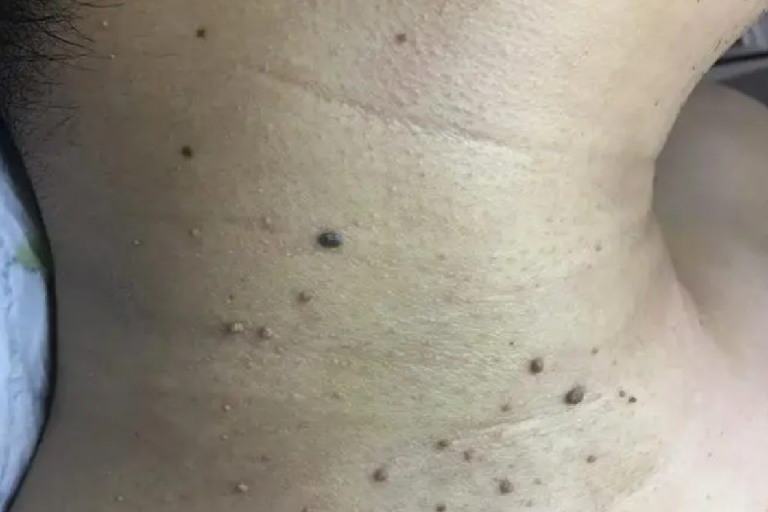 脖子上长丝状疣图片 | 百度健康·医学科普