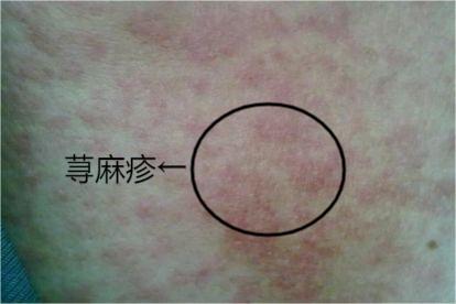 皮肤片状红疹图片 | 百度健康·医学科普