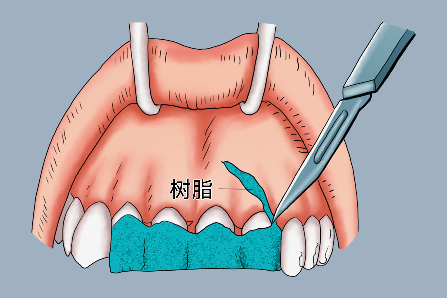 松牙固定术图解 | 百度健康·医学科普