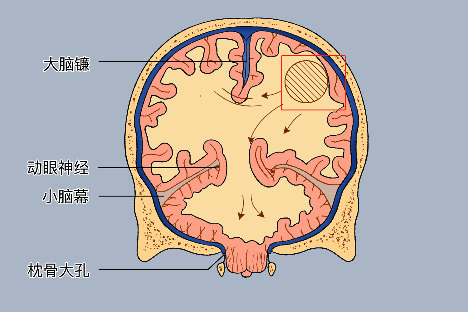脑疝的图片 | 百度健康·医学科普