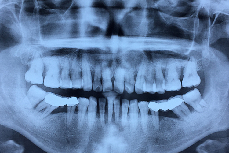 牙槽骨X线图