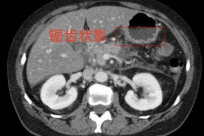 胃ct怎么看图解