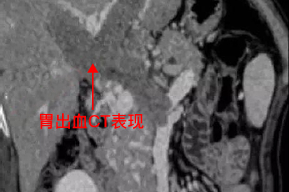 胃出血CT图片大全