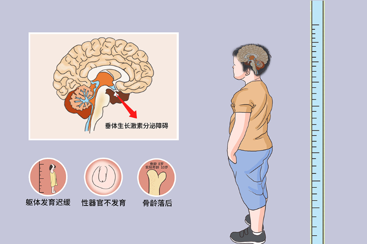 儿童侏儒症图片