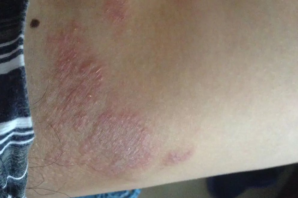 大腿根部股癣症状图片展示 
