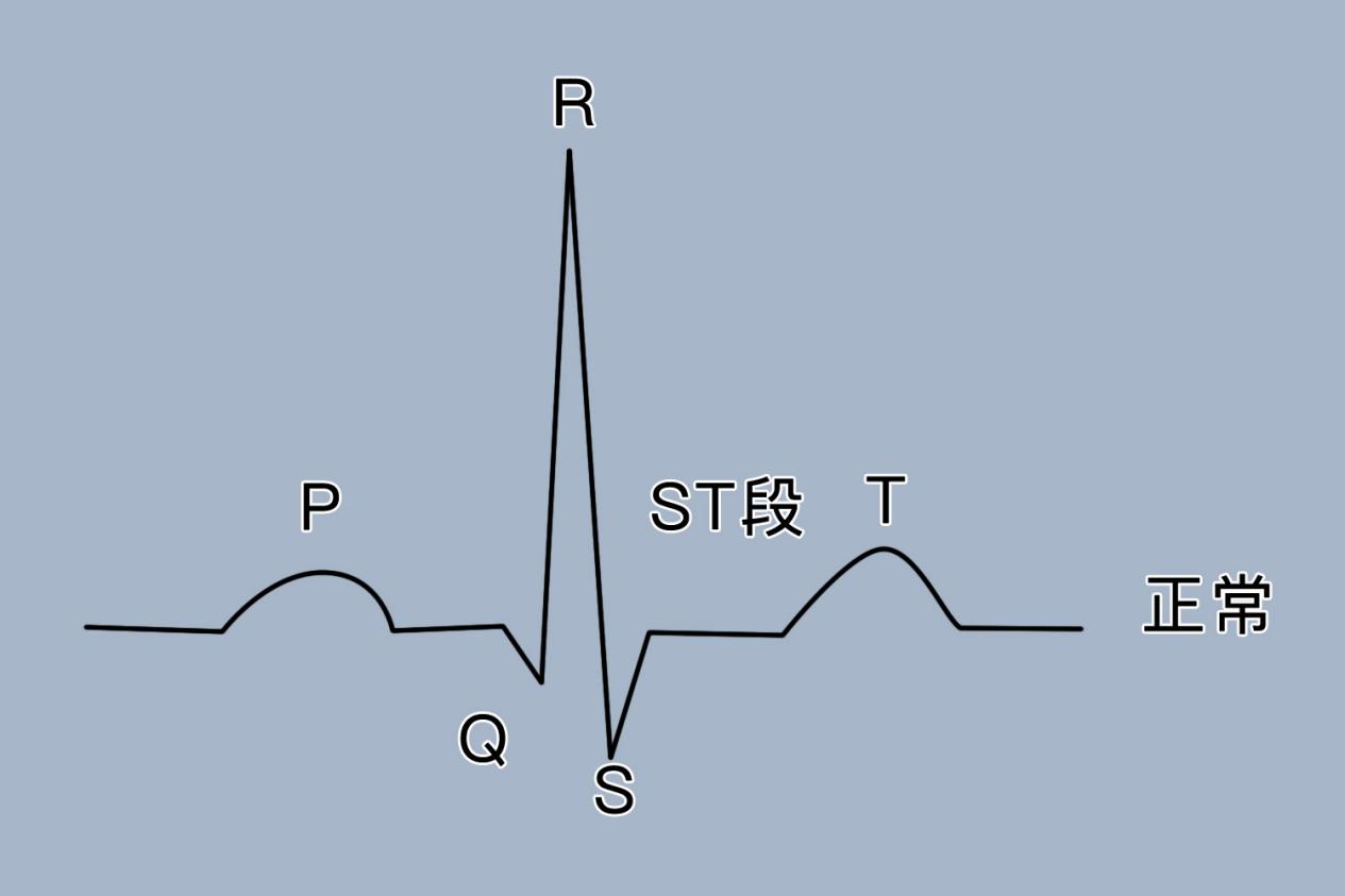 心电图显示st段改变是啥意思? | 百度健康·医学科普