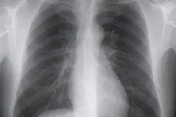 正常的X线胸片图
