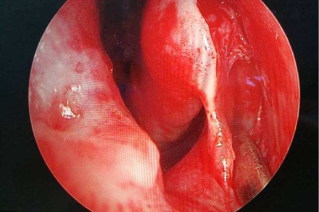 鼻内镜示鼻炎充血发炎图片