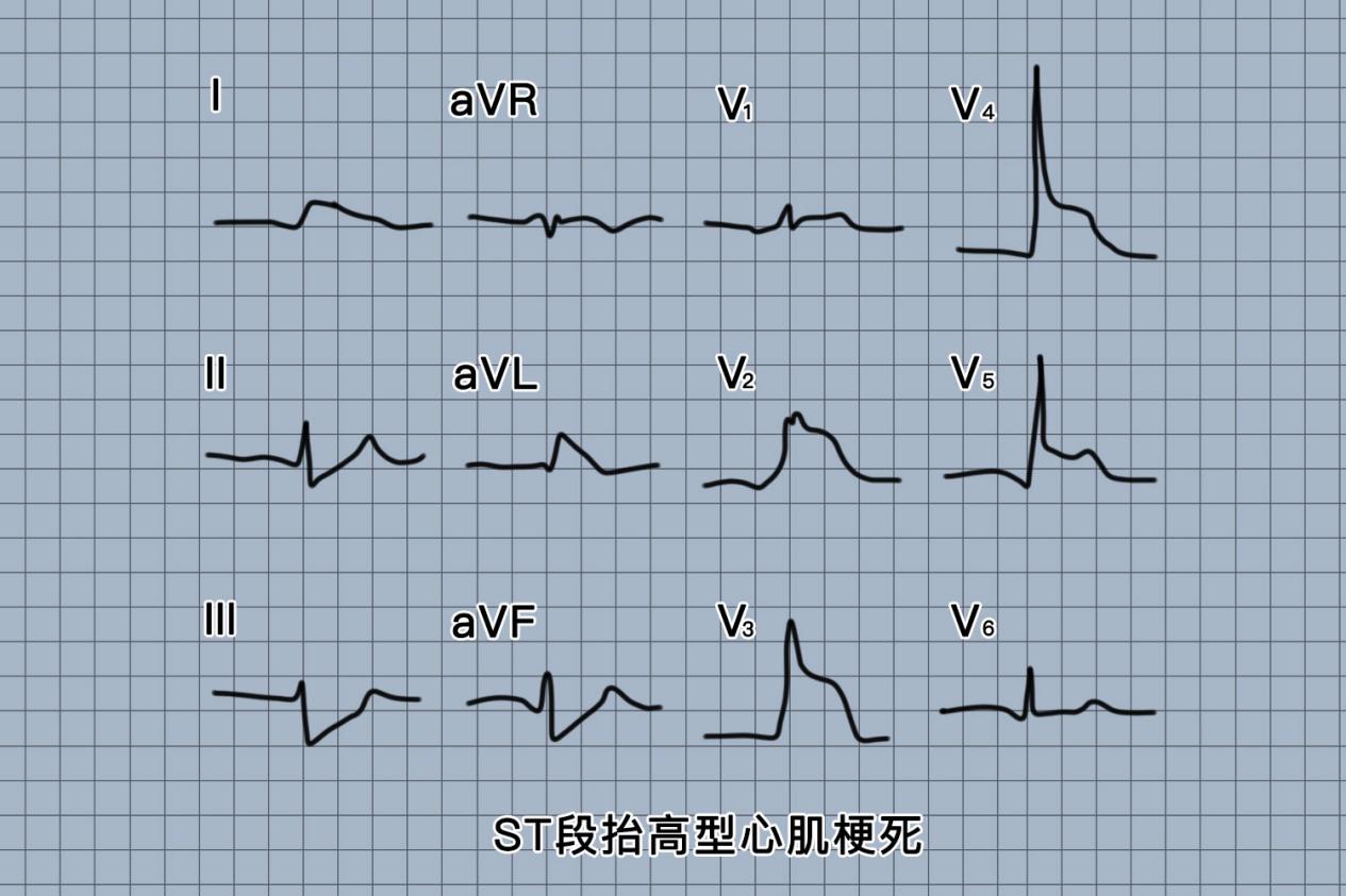 心电图st斜性抬高 | 百度健康·医学科普