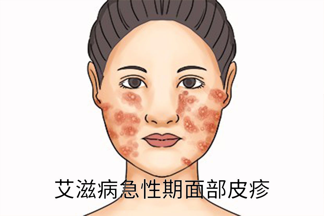 艾滋病急性期面部皮疹图片