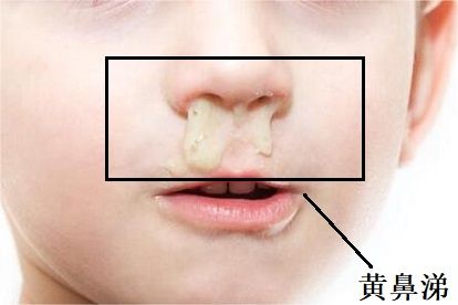 黄鼻涕和清鼻涕图片 | 百度健康·医学科普