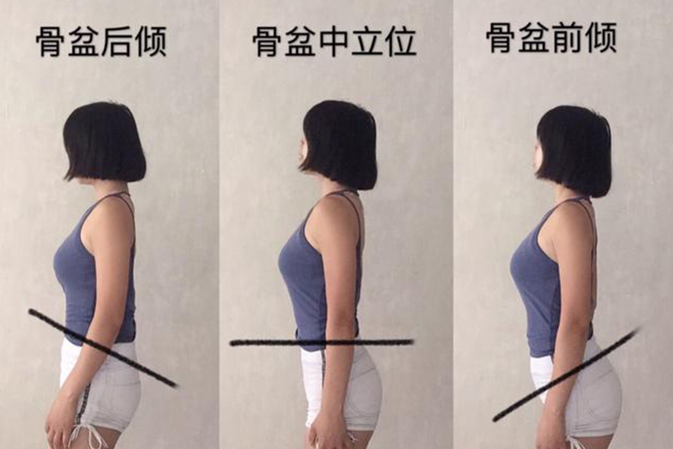 骨盆前倾后倾图 | 百度健康·医学科普