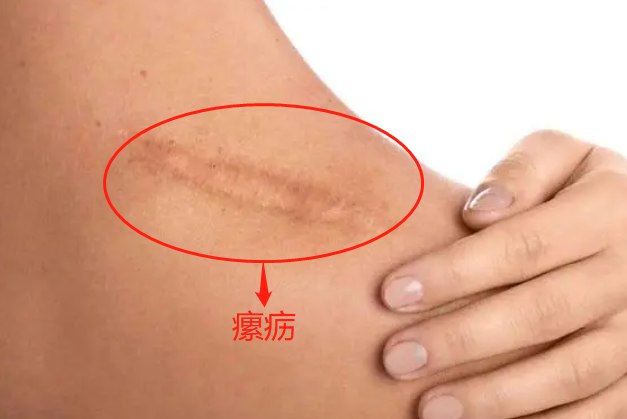 疖痈瘰疬图片