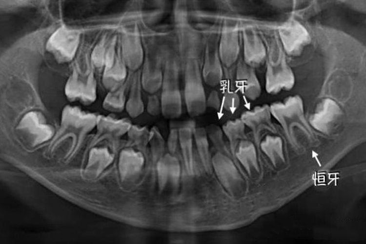 儿童正常牙片图