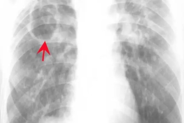 纤维空洞性肺结核X线图