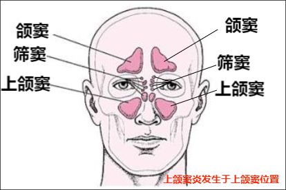 上颌窦炎的位置图片