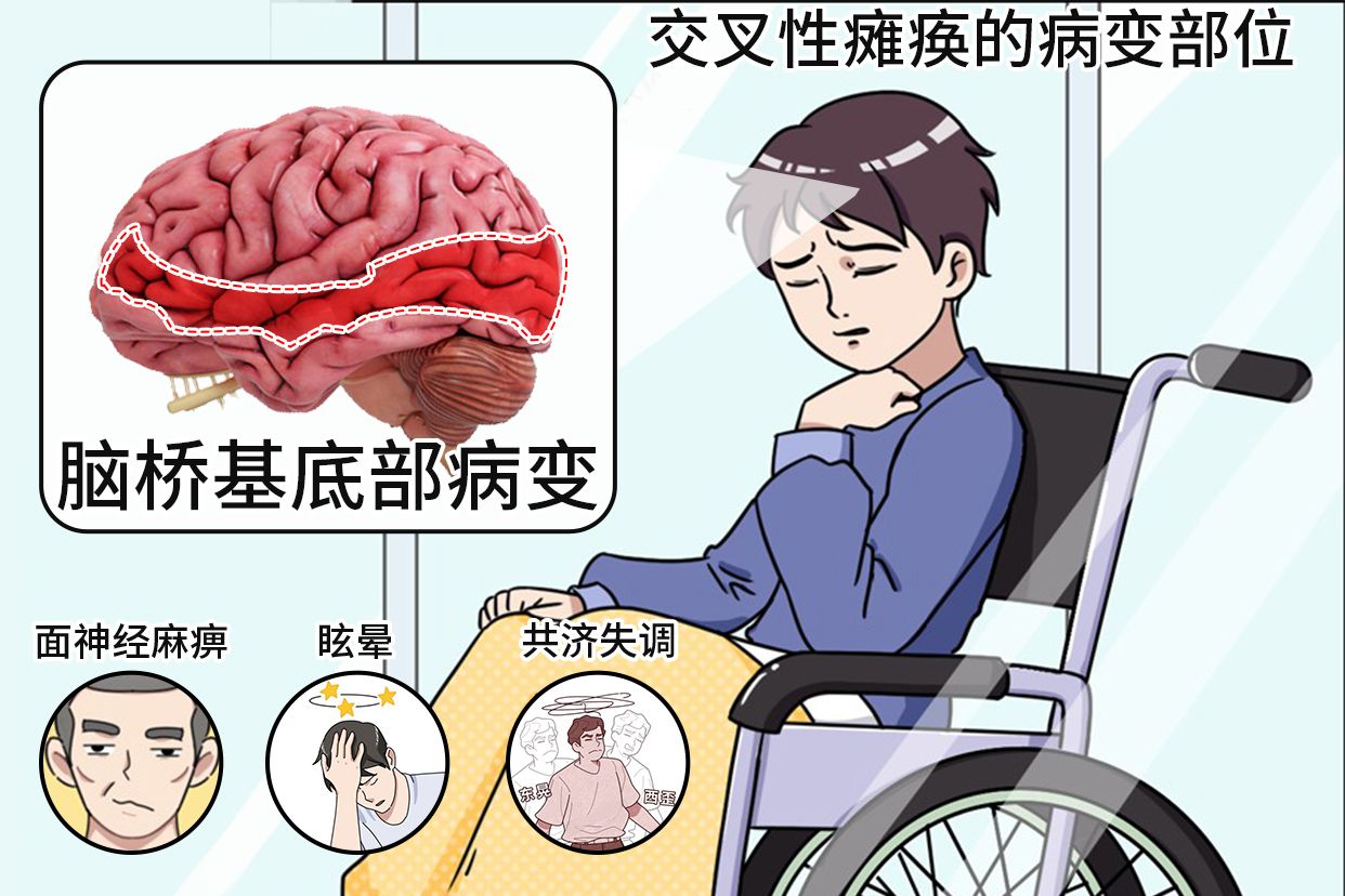 交叉性瘫痪的病变部位图