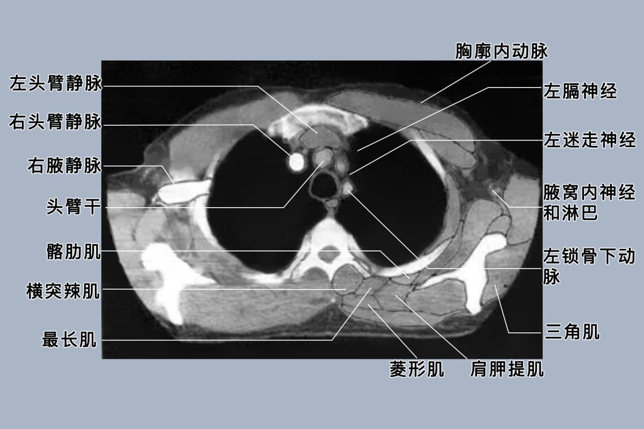 正常胸部CT图