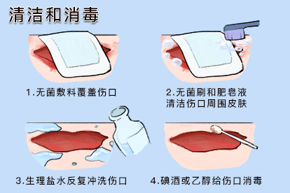 清创图片