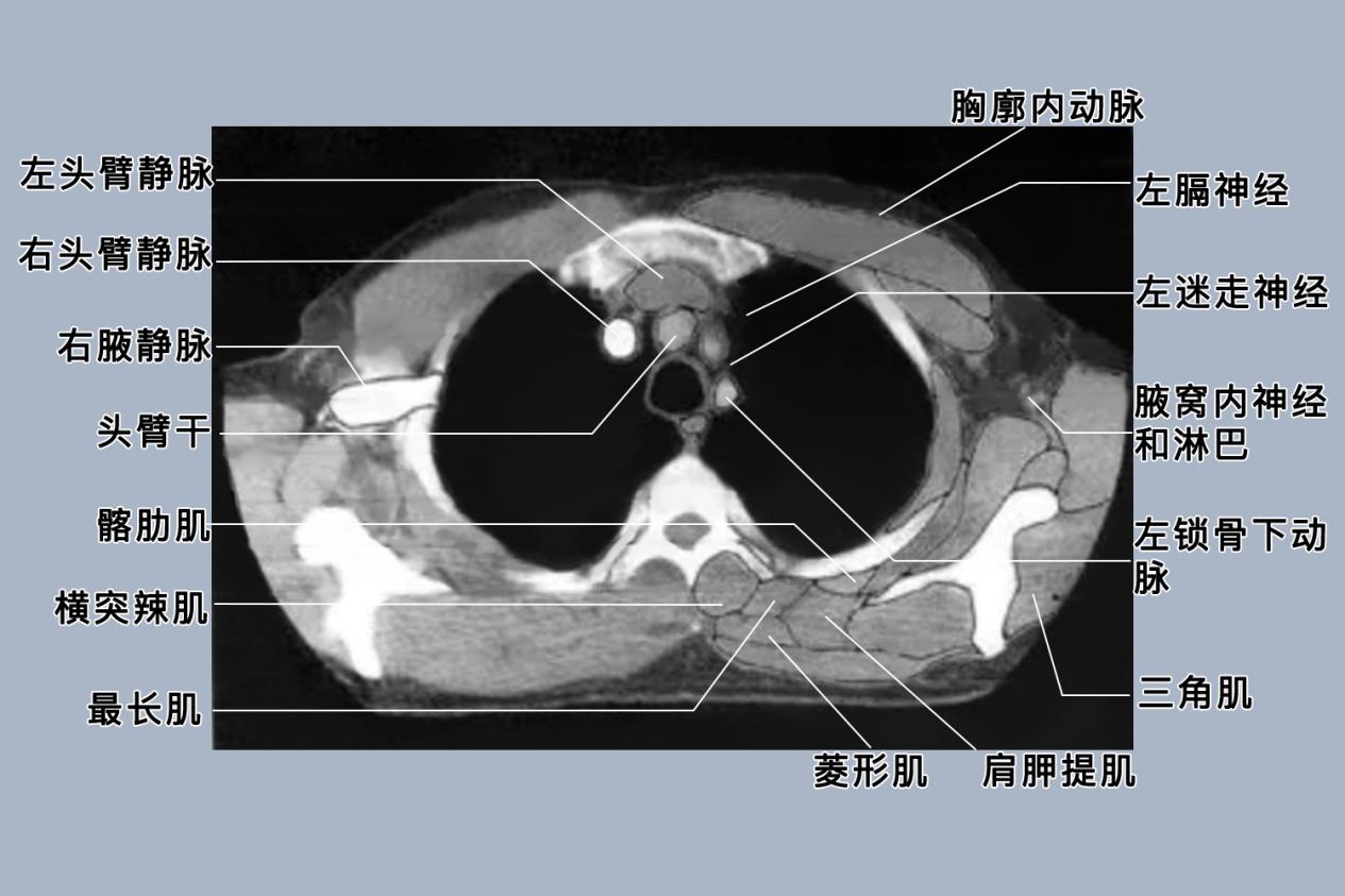 胸部CT解剖详细图