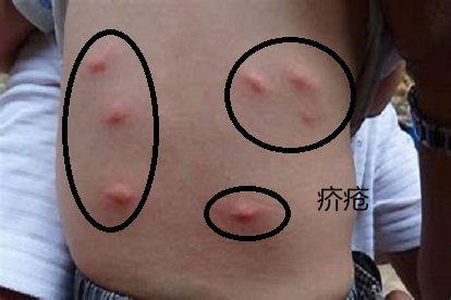 疥疮长在背上什么样子