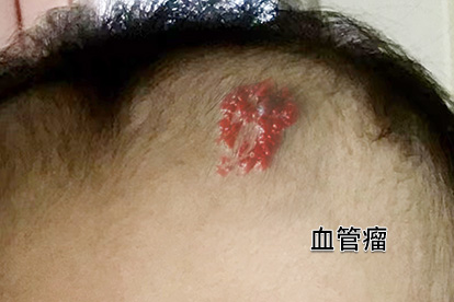 血痣和红痣的区别图片