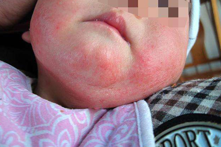 婴儿面部湿疹红斑图