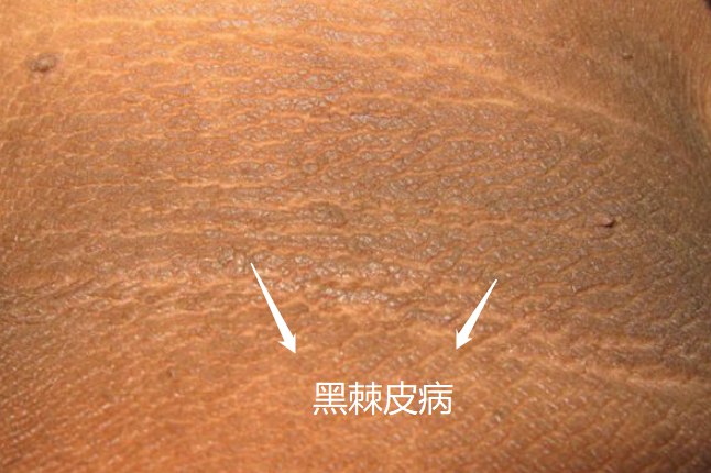 脖子上皮肤像鸡皮图片