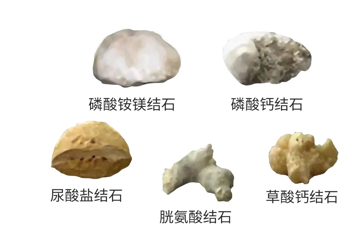 肾结石种类名称及图片