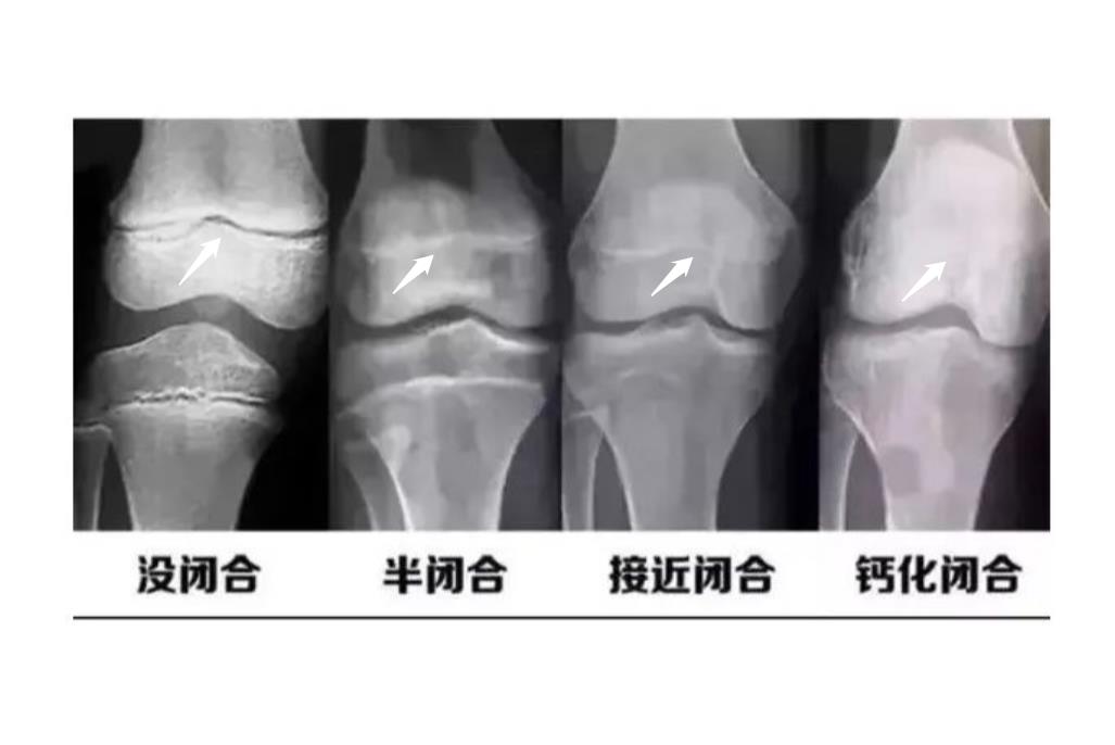 骨骺线参照图 | 百度健康·医学科普