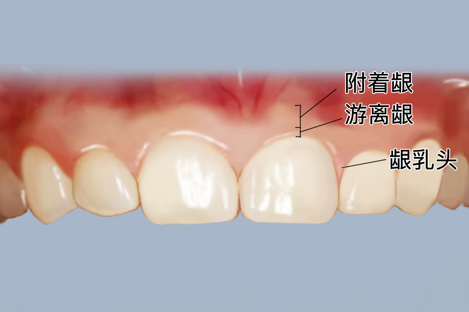 上颌牙牙龈图