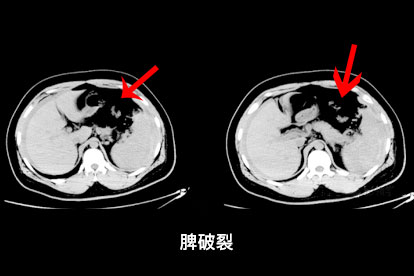 脾脏ct图像 | 百度健康·医学科普