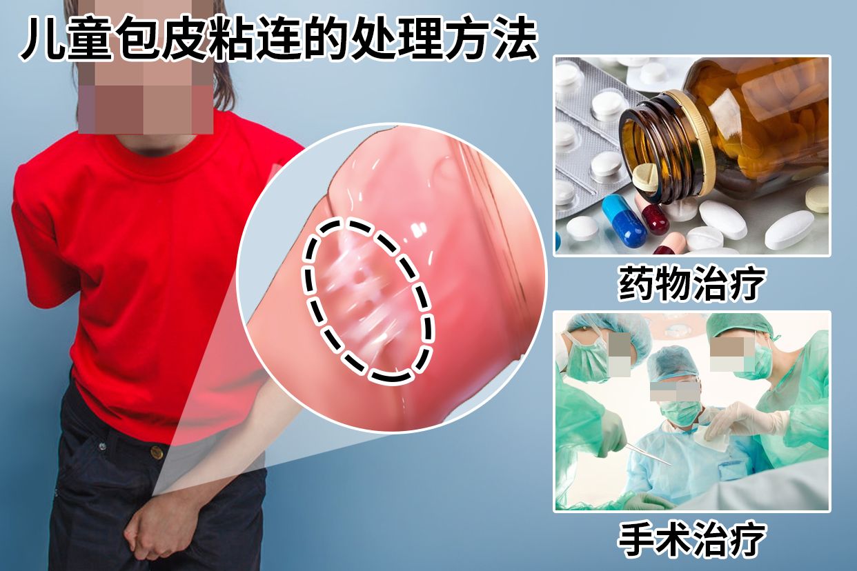 儿童包皮粘连的处理方法图片