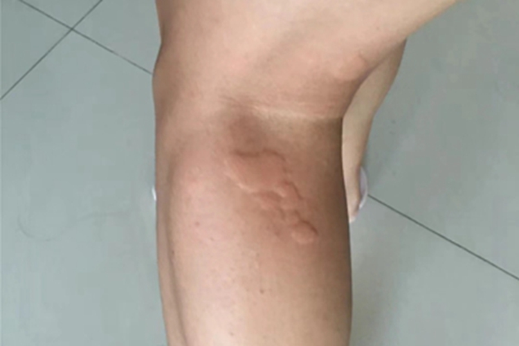 特应性皮炎出现风团图片