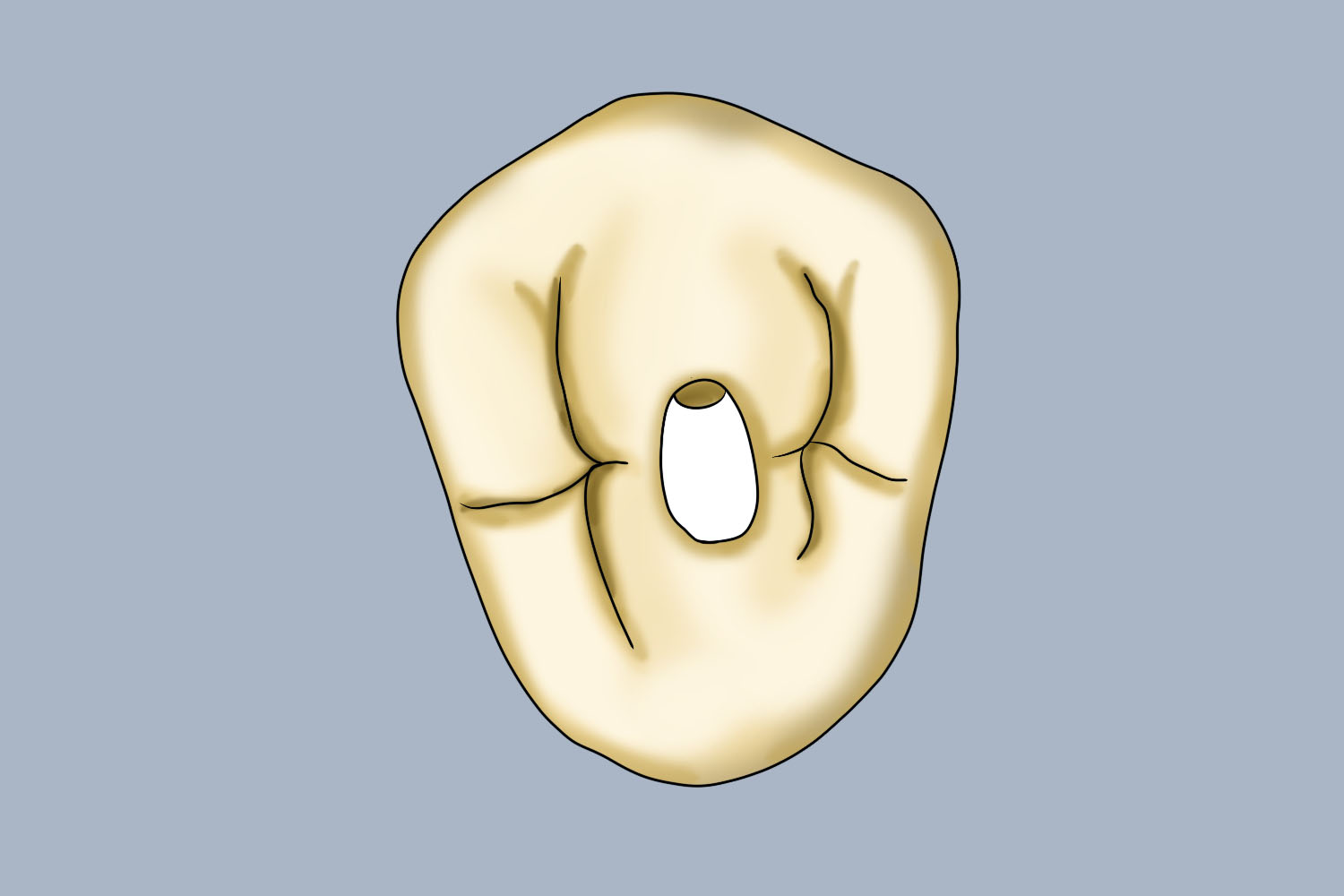 上颌前磨牙开髓洞形图