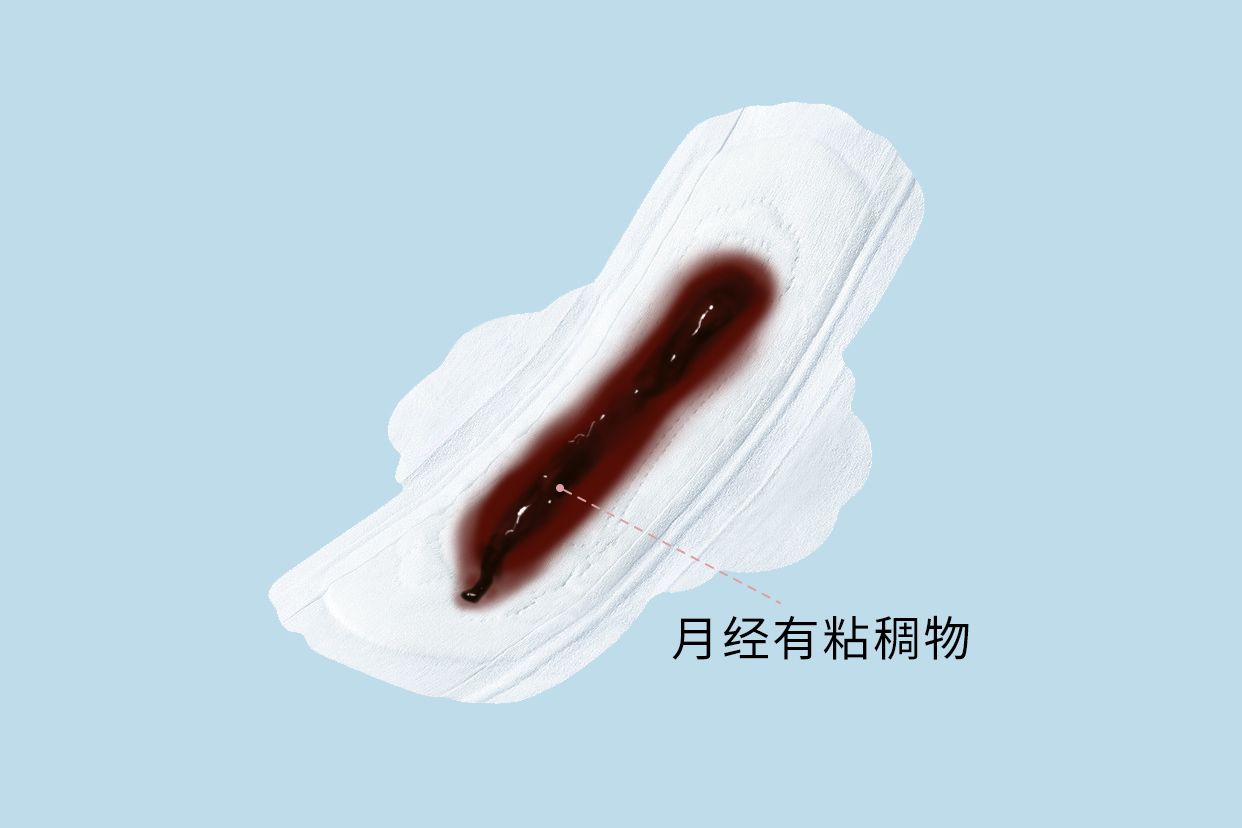 月经血里带粘液图片 | 百度健康·医学科普