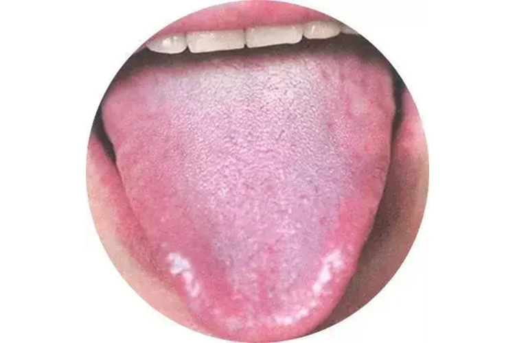 苔薄者舌苔图
