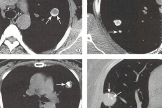 肺钙化灶CT图