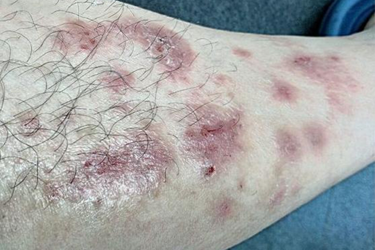 腿部皮肤出现红色斑块图片 | 百度健康·医学科普