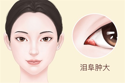 上火泪阜肿大图片