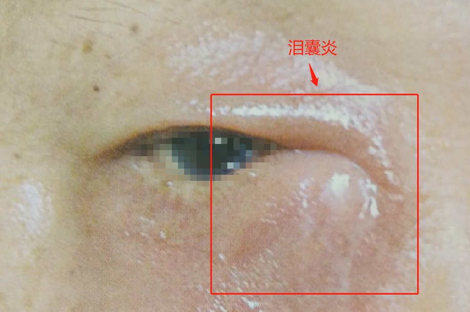 泪囊炎图片大全 | 百度健康·医学科普