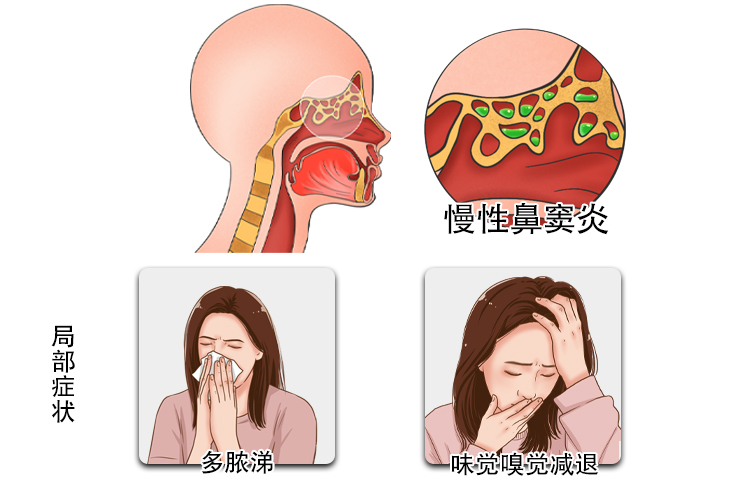 慢性鼻窦炎图片