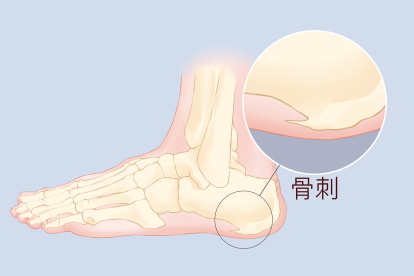 骨刺ct图